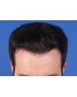 After Hair Transplant&nbsp;Hairlines